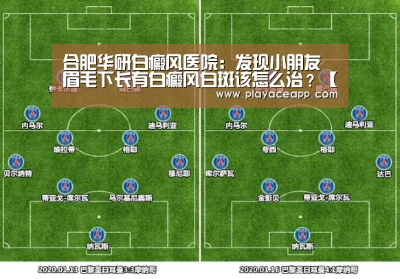 合肥华研白癜风医院:发现小朋友眉毛下长有白癜风白斑该怎么治?【PA真人】(图2) PA真人